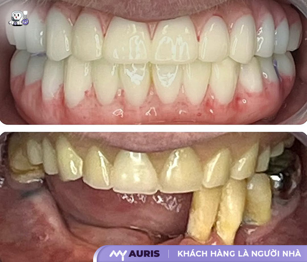 trồng răng hàm số 6 có đau không,trồng răng số 6 có đau không,trồng răng hàm đau không