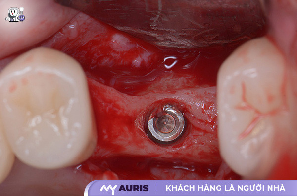 trồng răng hàm số 6 có đau không,trồng răng số 6 có đau không,trồng răng hàm đau không