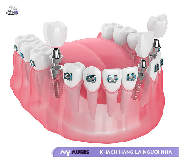 Trồng răng implant có niềng răng được không