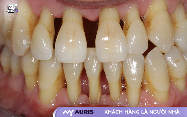 trồng răng implant có niềng răng được không,cắm implant có niềng răng được không,cắm implant rồi có niềng răng được không,cấy implant có niềng răng được không,nên niềng răng hay cắm implant,răng implant có niềng được không,trồng răng implant có niềng được không