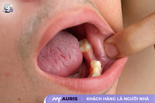 răng 7,răng số 7,vị trí răng số 7,răng số 7 là răng gì,nhổ răng số 7,răng số 7 có thay không,nhổ răng số 7 hàm trên có nguy hiểm không