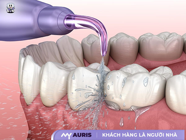 vệ sinh răng niềng,vệ sinh răng miệng khi niềng răng