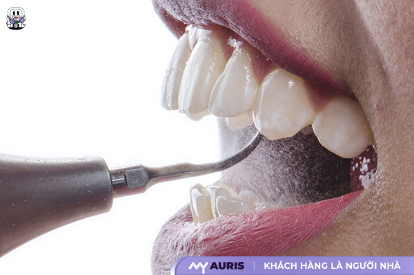 vệ sinh răng niềng,vệ sinh răng miệng khi niềng răng