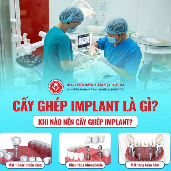 bảng giá trồng răng implant bệnh viện răng hàm mặt