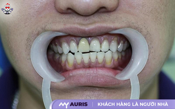 răng sứ titan vita,răng sứ titan có làm đen viền nướu,răng sứ titan vita có bị đen không