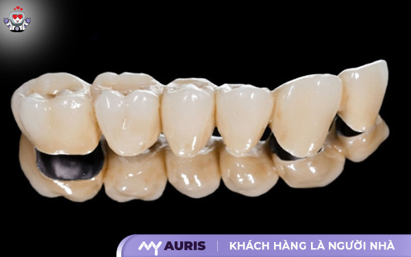 răng sứ titan vita,răng sứ titan có làm đen viền nướu,răng sứ titan vita có bị đen không