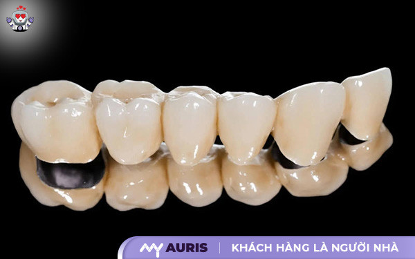 răng sứ titan vita,răng sứ titan có làm đen viền nướu,răng sứ titan vita có bị đen không