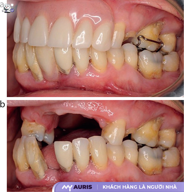 trồng răng implant có mấy loại,cấy implant loại nào tốt,hậu quả trồng răng sứ,nên cắm implant loại nào,trồng răng có mấy loại,trồng răng implant loại nào tốt