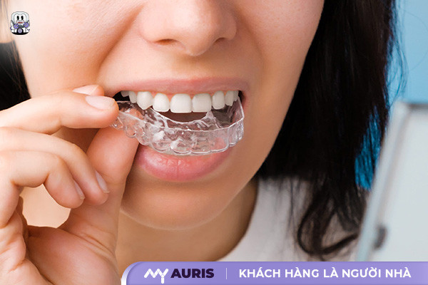 khuôn niềng răng,niềng răng bằng khuôn