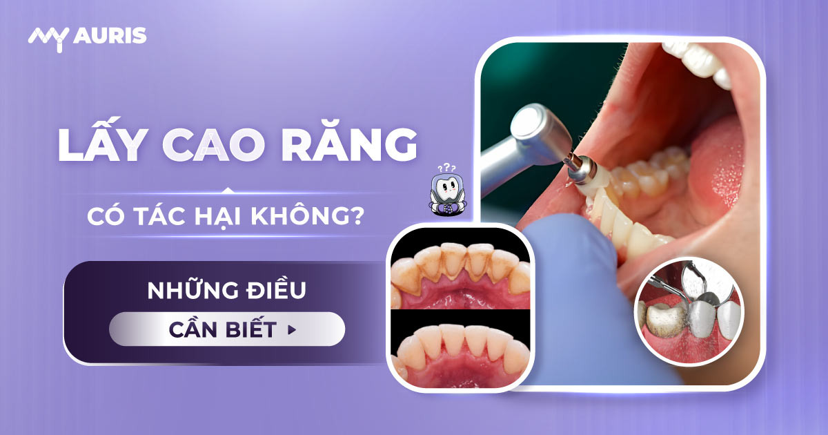 lấy cao răng,tác hại của việc lấy cao răng ,lấy cao răng có tốt không,có nên lấy cao răng không,có nên lấy cao răng