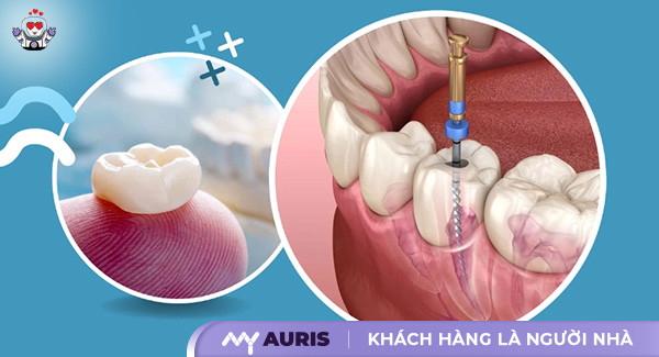 trồng răng có được hưởng bảo hiểm y tế không