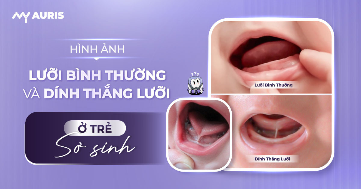 lưỡi bình thường và dính thắng lưỡi