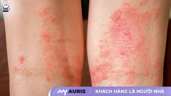 nổi mẩn đỏ ngứa như muỗi đốt