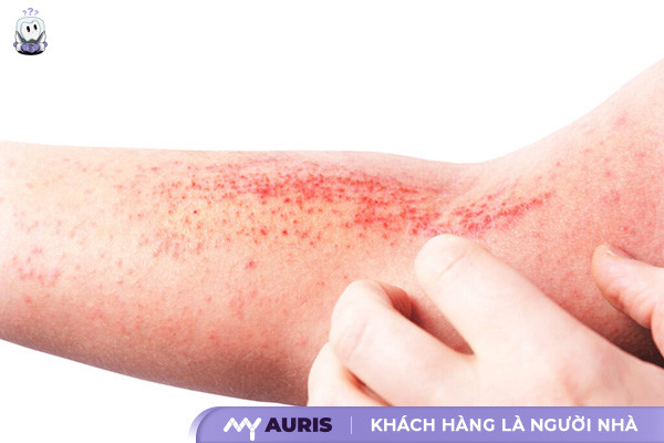 nổi mẩn đỏ ngứa như muỗi đốt