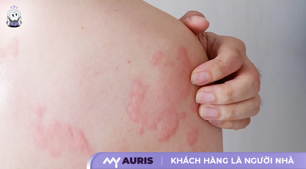nổi mẩn đỏ ngứa như muỗi đốt