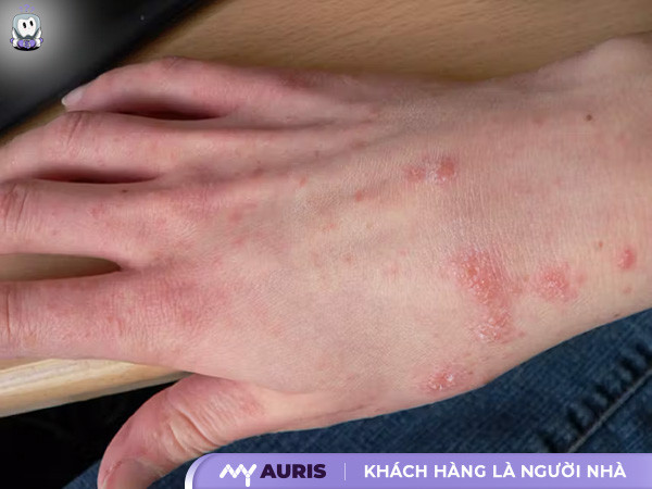 nổi mẩn đỏ ngứa như muỗi đốt