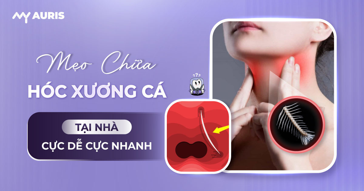 mẹo chữa hóc xương cá,mẹo chữa hóc xương cá bằng đũa