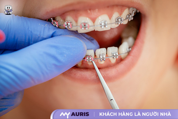 niềng răng 10 triệu