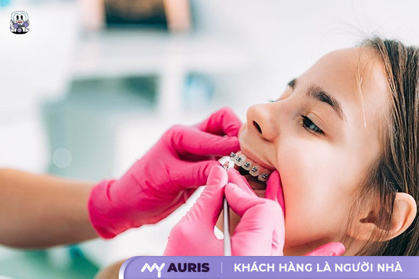 13 tuổi niềng răng bao nhiêu tiền,giá niềng răng cho trẻ 13 tuổi,niềng răng cho trẻ 13 tuổi