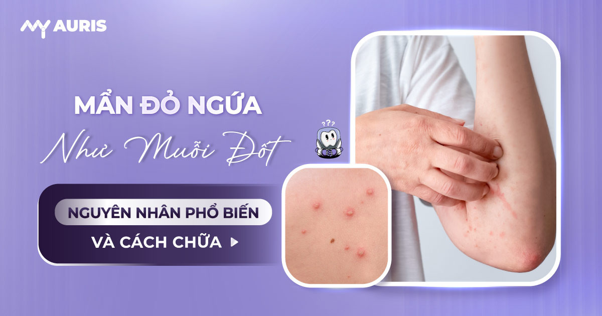 nổi mẩn đỏ ngứa như muỗi đốt