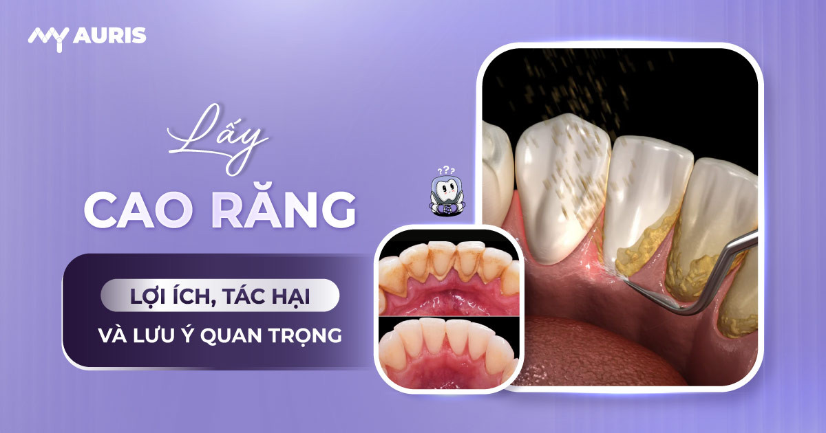 tác hại của việc lấy cao răng