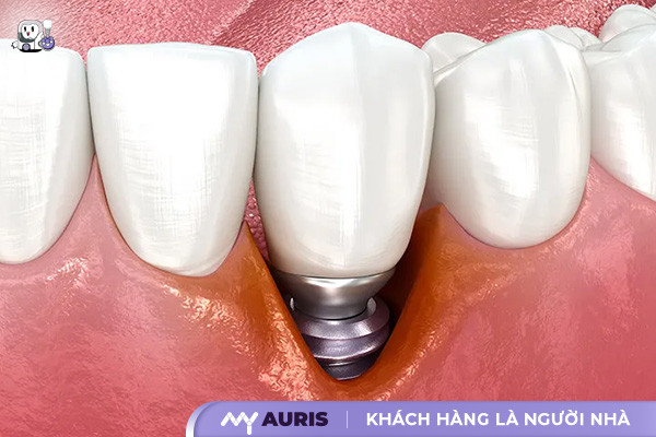 tiểu đường có cắm implant được không