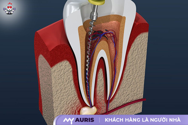 bọc răng sứ có lấy tủy không