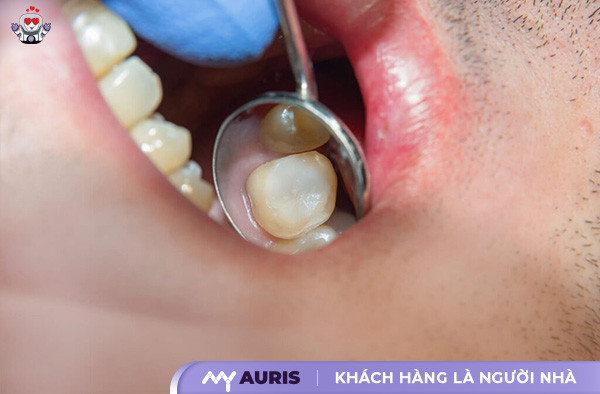 bọc răng sứ có lấy tủy không