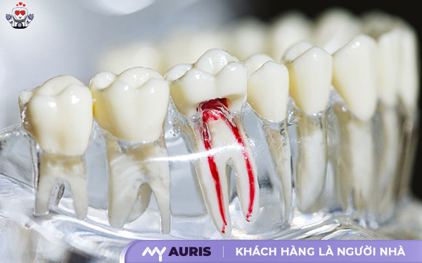 bọc răng sứ có lấy tủy không