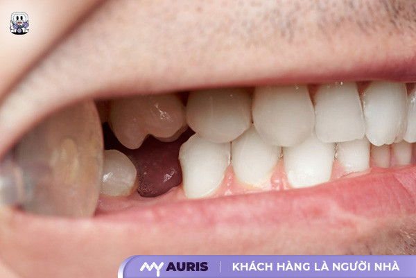 mất răng số 6 có niềng răng được không