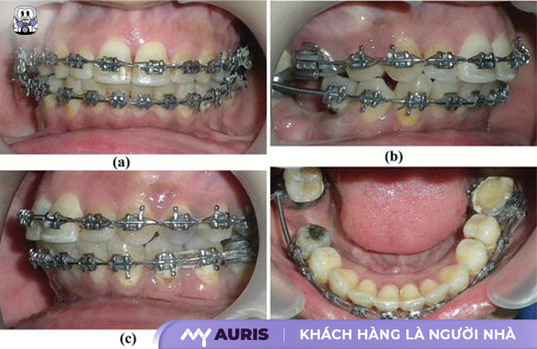mat-rang-so-6-co-nieng-duoc-khong-13-2-25-03