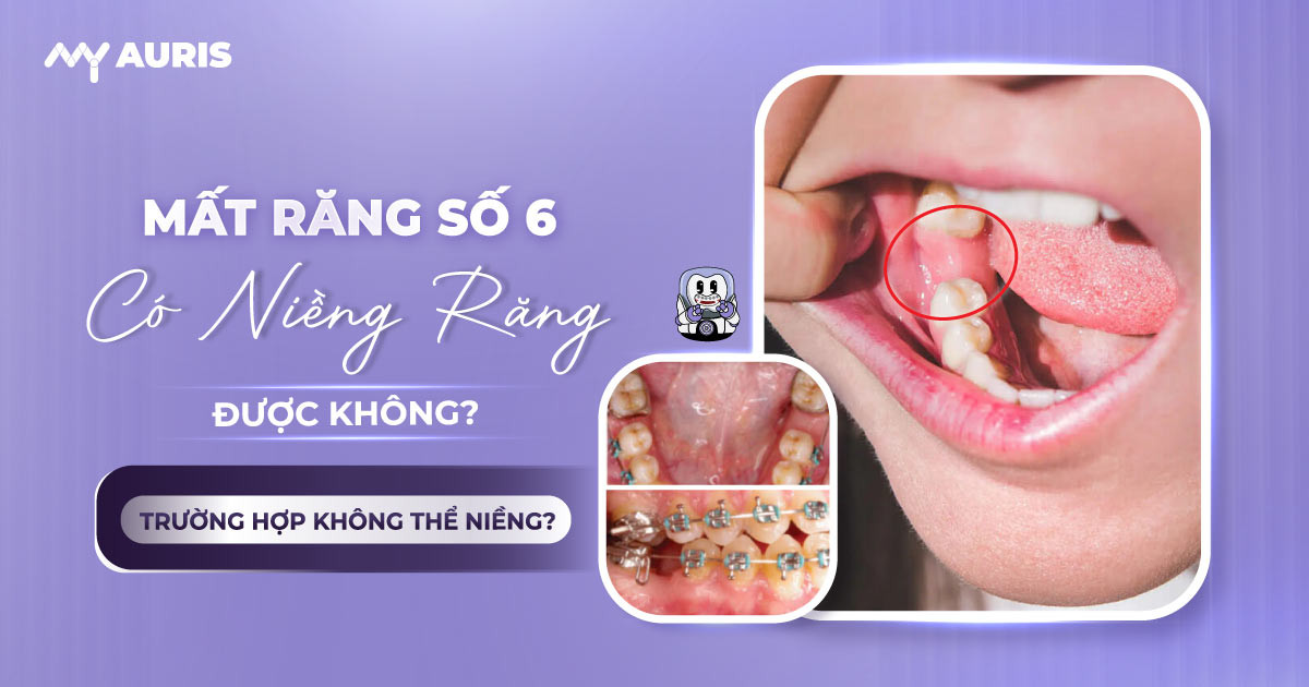 mất răng số 6 có niềng răng được không