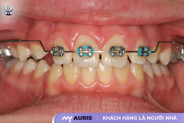Niềng răng một hàm cho răng thưa