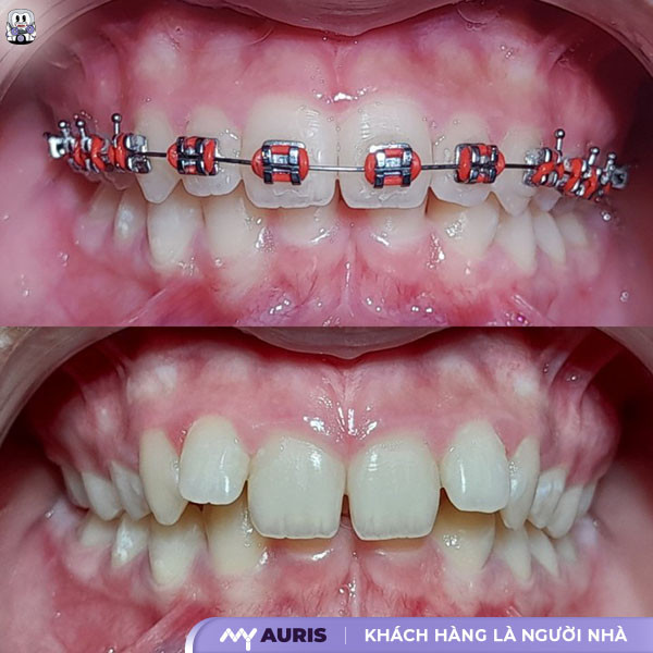 Niềng răng một hàm cho răng hô