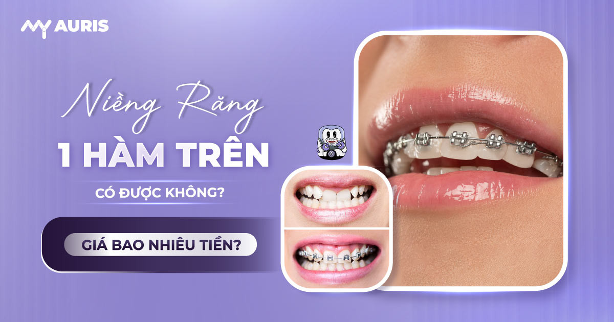 niềng răng 1 hàm trên có được không