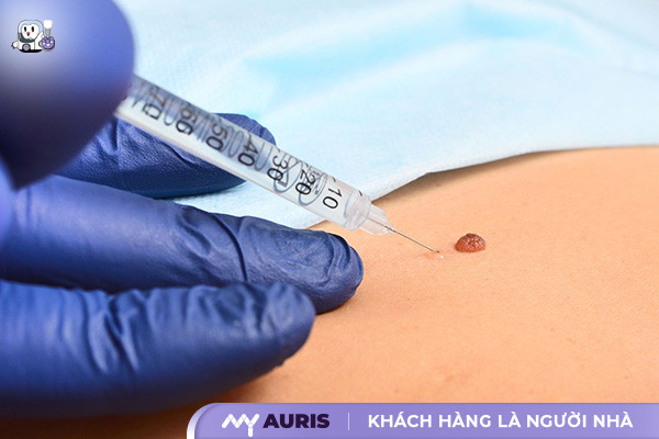 trồng răng implant có gây mê không