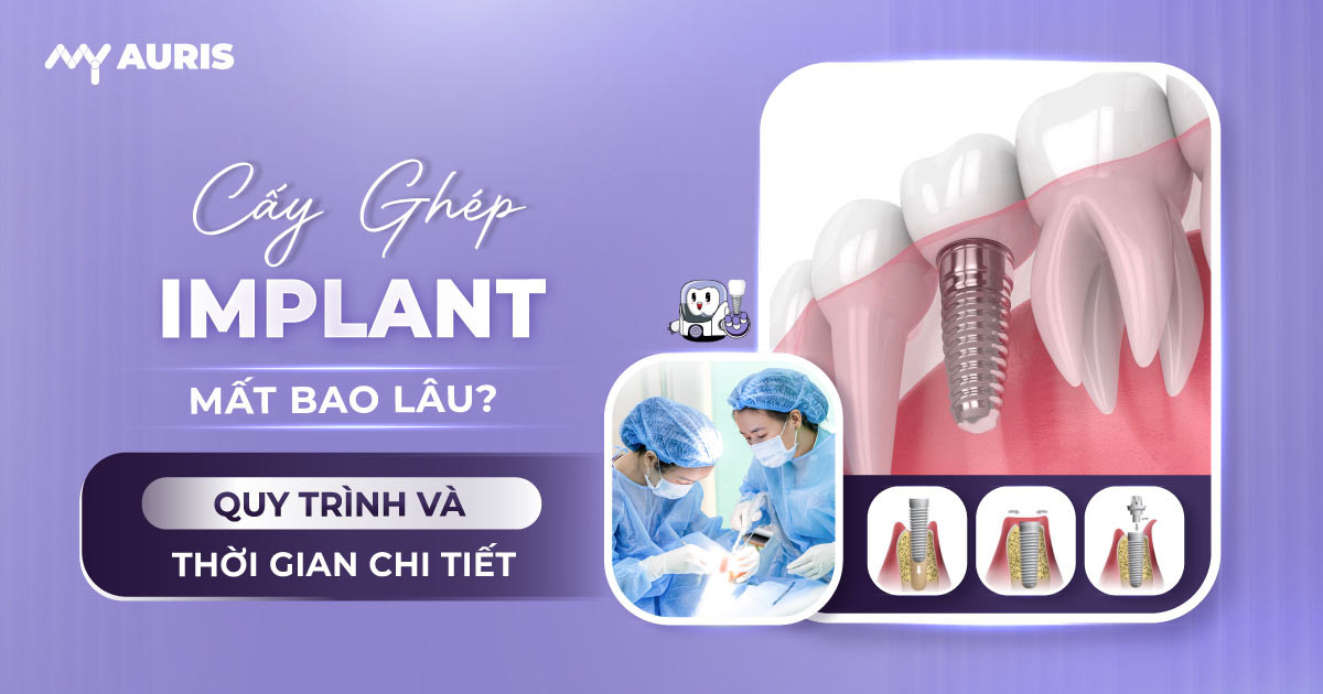 cắm trụ implant mất bao lâu