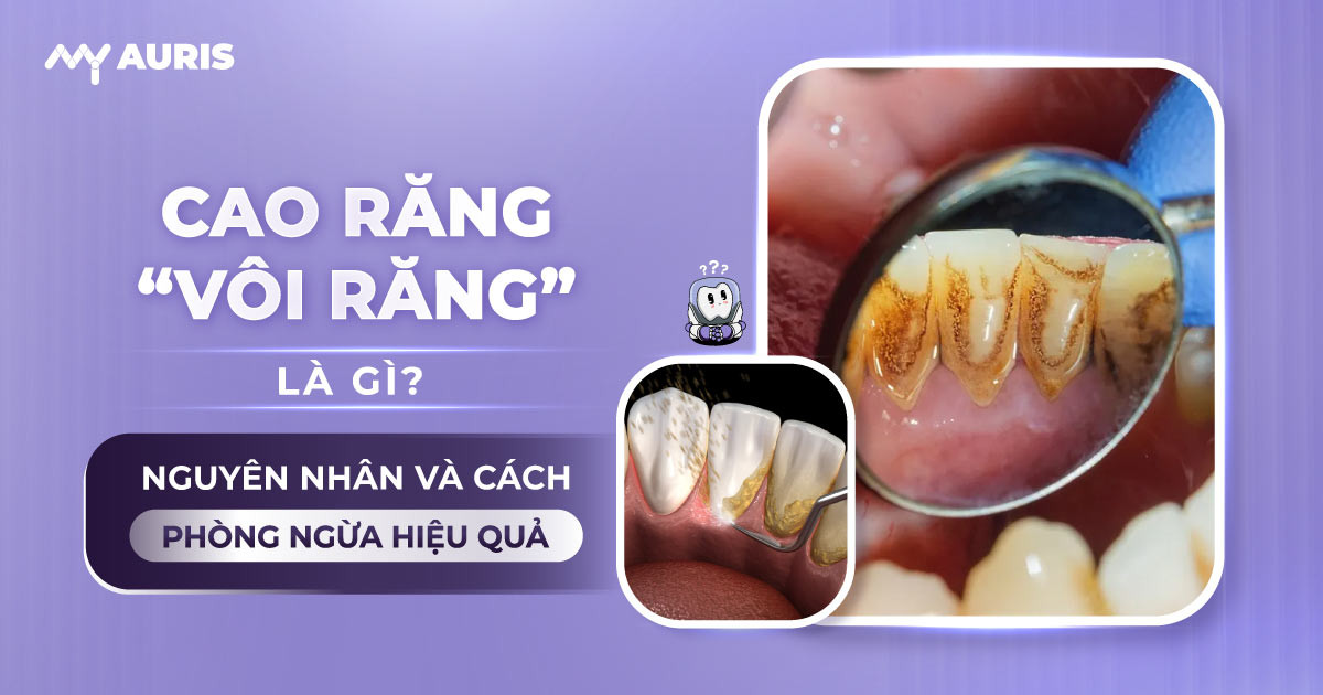cao răng,cao răng là gì,vôi răng là gì,vôi răng