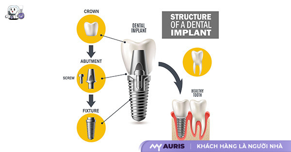 cấu tạo implant