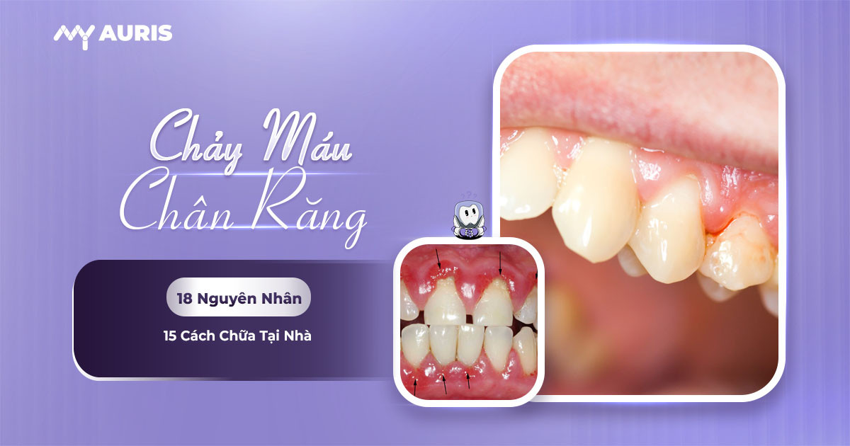 chảy máu chân răng