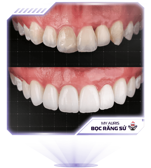 img-boc-rang-su-min