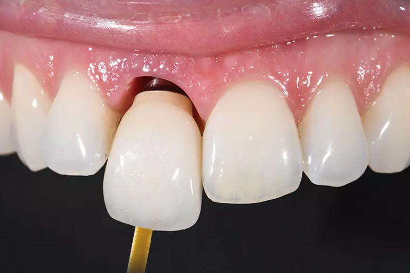 img-gan-mao-su-implant