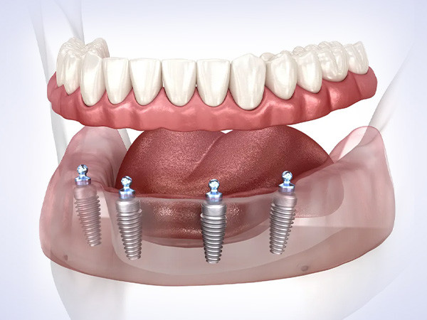 img-implant-toan-ham