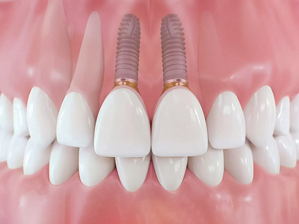 img-trong-implant-2-rang-cua