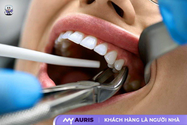 niềng răng hô có cần nhổ răng không,niềng răng hô có cần phải nhổ răng không