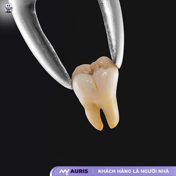 niềng răng hô có cần nhổ răng không,niềng răng hô có cần phải nhổ răng không