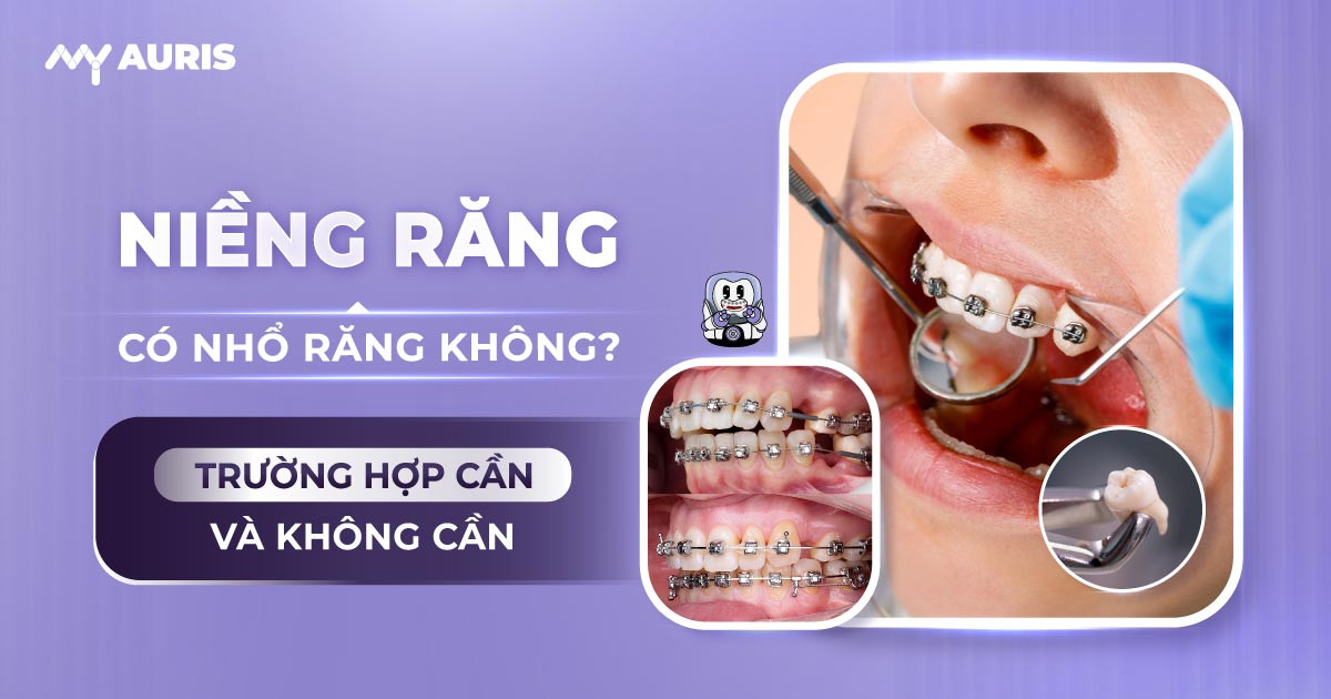 niềng răng hô có cần nhổ răng không,niềng răng hô có cần phải nhổ răng không