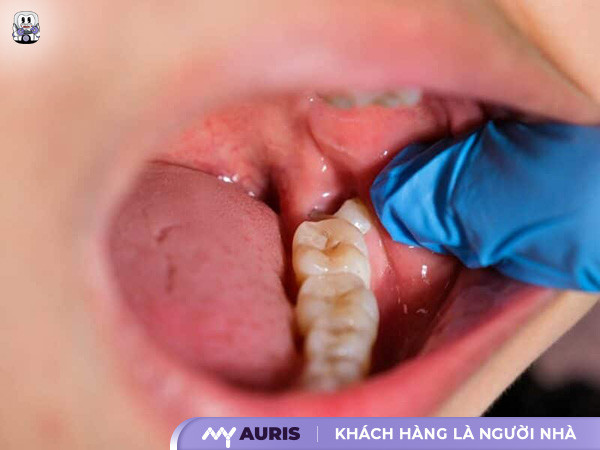 niềng răng invisalign có nhổ răng không,niềng răng trong suốt có cần nhổ răng không