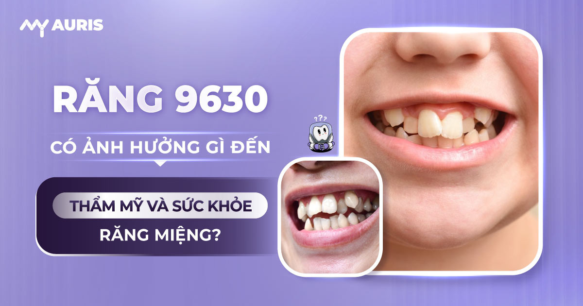 răng 9-6-3-0, răng 9630