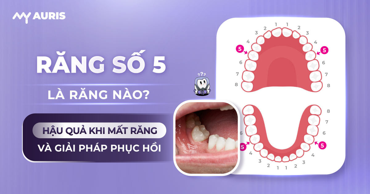 răng 5,răng số 5,răng số 5 hàm dưới